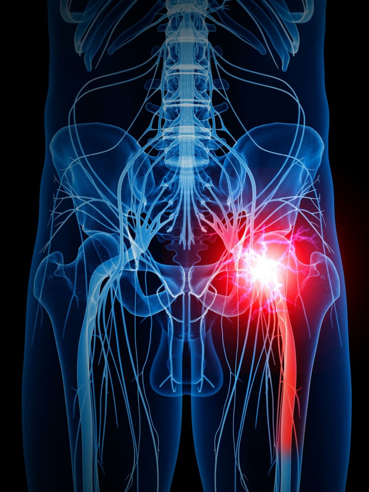 sciatica nerve pain spreading into the leg, a sign of sciatica